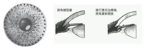 青光眼,希瑪瑞視眼科,上海眼科醫(yī)院