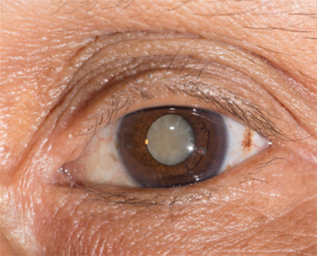 白內障,?，斎鹨曆劭?上海眼科醫院