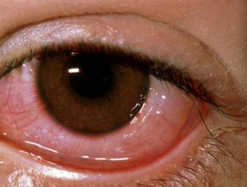 眼表眼角膜,希瑪瑞視眼科,上海眼科醫院 眼表眼角膜,希瑪瑞視眼科,上海眼科醫院