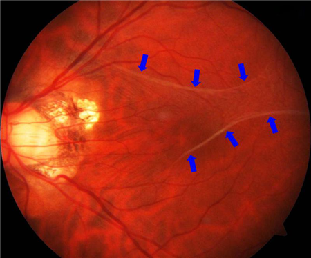 玻璃體視網(wǎng)膜,希瑪瑞視眼科,上海眼科醫(yī)院