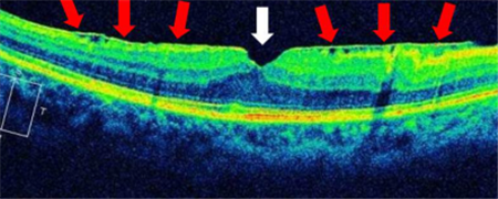 玻璃體視網(wǎng)膜,希瑪瑞視眼科,上海眼科醫(yī)院
