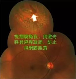 玻璃體視網膜,希瑪瑞視眼科,上海眼科醫院