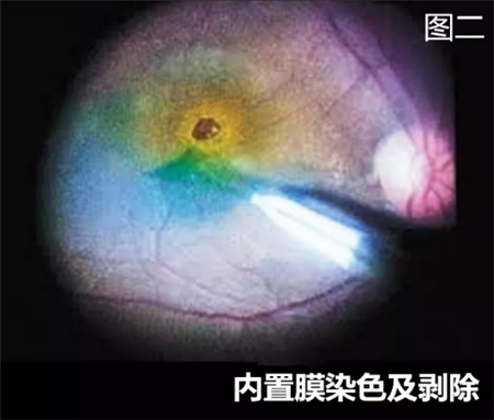 玻璃體視網膜,希瑪瑞視眼科,上海眼科醫院 玻璃體視網膜,希瑪瑞視眼科,上海眼科醫院