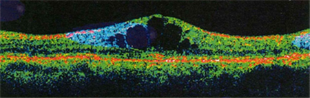 玻璃體視網膜,希瑪瑞視眼科,上海眼科醫院 玻璃體視網膜,希瑪瑞視眼科,上海眼科醫院