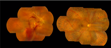 玻璃體視網膜,希瑪瑞視眼科,上海眼科醫院 玻璃體視網膜,希瑪瑞視眼科,上海眼科醫院