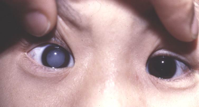 白內障,?，斎鹨曆劭?上海眼科醫院