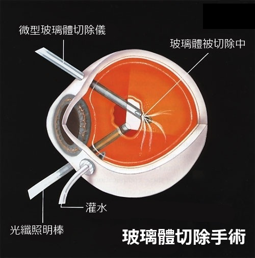 玻璃體視網膜,希瑪瑞視眼科,上海眼科醫院 玻璃體視網膜,希瑪瑞視眼科,上海眼科醫院