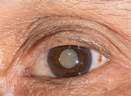 白內障,希瑪瑞視眼科,上海眼科醫院 白內障,希瑪瑞視眼科,上海眼科醫院