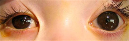 青光眼,希瑪瑞視眼科,上海眼科醫(yī)院 青光眼,希瑪瑞視眼科,上海眼科醫(yī)院