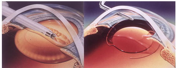 青光眼,希瑪瑞視眼科,上海眼科醫院 青光眼,希瑪瑞視眼科,上海眼科醫院