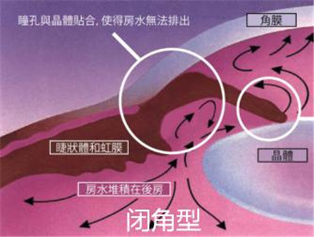 青光眼,希瑪瑞視眼科,上海眼科醫(yī)院 青光眼,希瑪瑞視眼科,上海眼科醫(yī)院