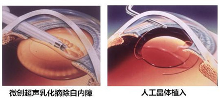 白內障,希瑪瑞視眼科,上海眼科醫院 白內障,希瑪瑞視眼科,上海眼科醫院