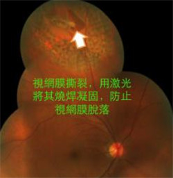 玻璃體視網膜,希瑪瑞視眼科,上海眼科醫(yī)院 玻璃體視網膜,希瑪瑞視眼科,上海眼科醫(yī)院