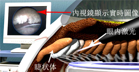 青光眼,希瑪瑞視眼科,上海眼科醫(yī)院 青光眼,希瑪瑞視眼科,上海眼科醫(yī)院