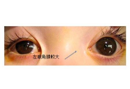 青光眼,希瑪瑞視眼科,上海眼科醫院