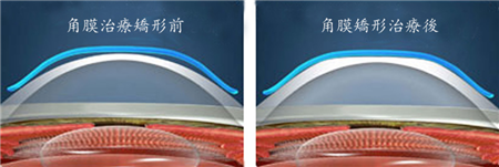 屈光矯視,希瑪瑞視眼科,上海眼科醫院