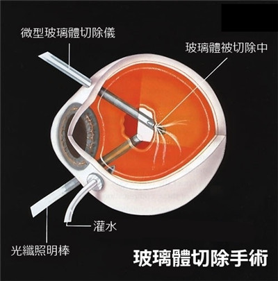 玻璃體視網膜,希瑪瑞視眼科,上海眼科醫院 玻璃體視網膜,希瑪瑞視眼科,上海眼科醫院