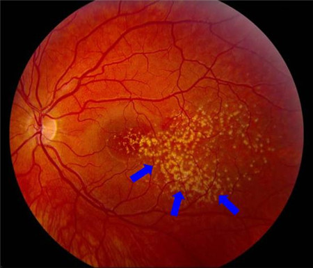 玻璃體視網膜,希瑪瑞視眼科,上海眼科醫院 玻璃體視網膜,希瑪瑞視眼科,上海眼科醫院