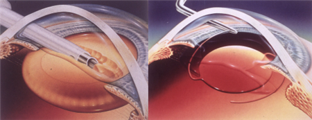 白內障,?，斎鹨曆劭?上海眼科醫院