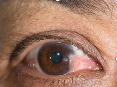 眼表眼角膜,希瑪瑞視眼科,上海眼科醫院