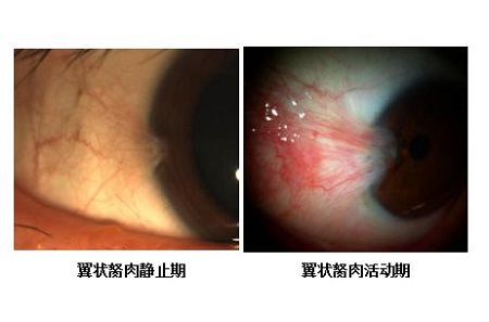 眼表眼角膜,希瑪瑞視眼科,上海眼科醫院