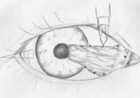 眼表眼角膜,希瑪瑞視眼科,上海眼科醫院