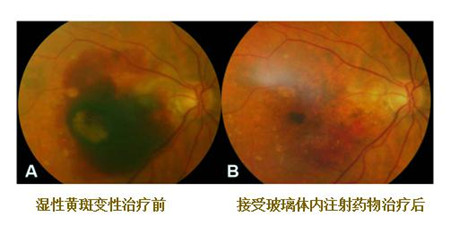 玻璃體視網膜,?，斎鹨曆劭?上海眼科醫院