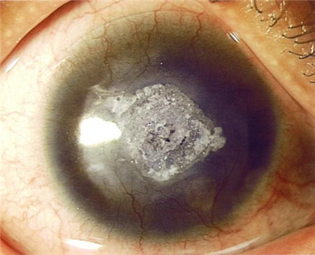 眼表眼角膜,希瑪瑞視眼科,上海眼科醫(yī)院