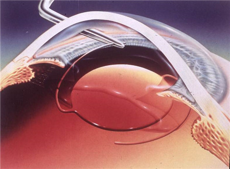 白內障,希瑪瑞視眼科,上海眼科醫院 白內障,希瑪瑞視眼科,上海眼科醫院