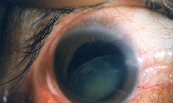 白內(nèi)障,希瑪瑞視眼科,上海眼科醫(yī)院 白內(nèi)障,希瑪瑞視眼科,上海眼科醫(yī)院