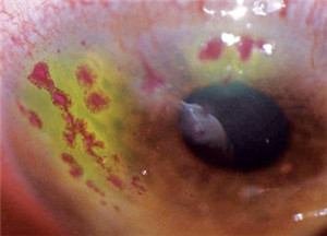 眼表眼角膜,?，斎鹨曆劭?上海眼科醫院