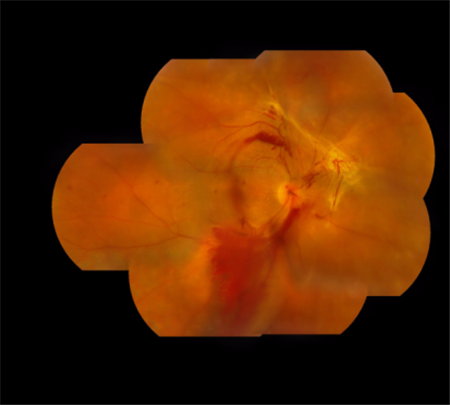 玻璃體視網(wǎng)膜,希瑪瑞視眼科,上海眼科醫(yī)院 玻璃體視網(wǎng)膜,希瑪瑞視眼科,上海眼科醫(yī)院