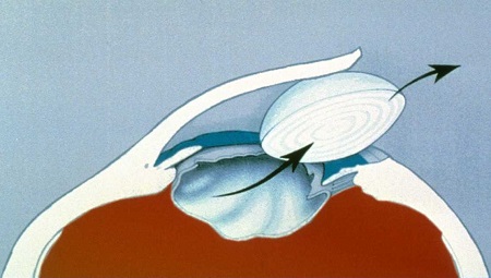 白內障,?，斎鹨曆劭?上海眼科醫院