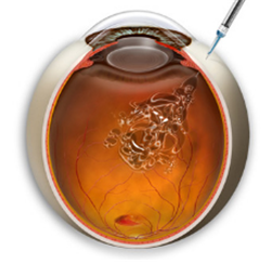 玻璃體視網膜,?，斎鹨曆劭?上海眼科醫院