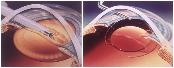 白內障,希瑪瑞視眼科,上海眼科醫院