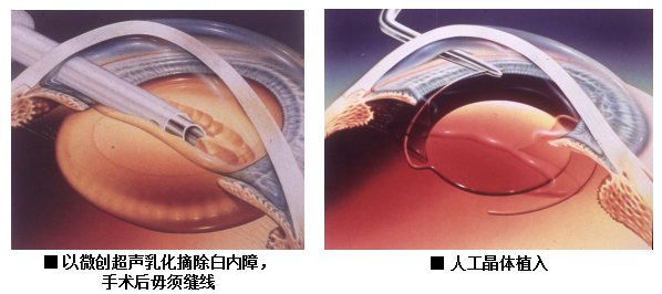 白內(nèi)障,希瑪瑞視眼科,上海眼科醫(yī)院