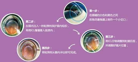 屈光矯視,希瑪瑞視眼科,上海眼科醫院 屈光矯視,希瑪瑞視眼科,上海眼科醫院