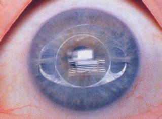 屈光矯視,希瑪瑞視眼科,上海眼科醫院 屈光矯視,希瑪瑞視眼科,上海眼科醫院