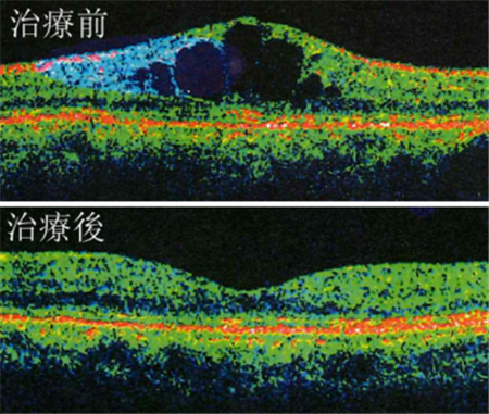 玻璃體視網(wǎng)膜,?，斎鹨曆劭?上海眼科醫(yī)院