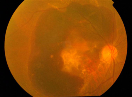 眼表眼角膜,希瑪瑞視眼科,上海眼科醫院 眼表眼角膜,希瑪瑞視眼科,上海眼科醫院