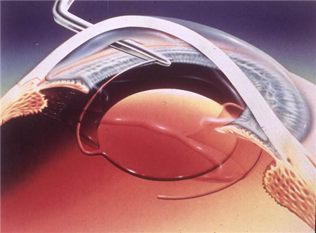 白內障,?，斎鹨曆劭?上海眼科醫院