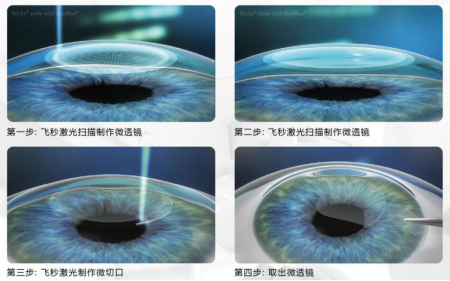 屈光矯視,希瑪瑞視眼科,上海眼科醫(yī)院 屈光矯視,希瑪瑞視眼科,上海眼科醫(yī)院