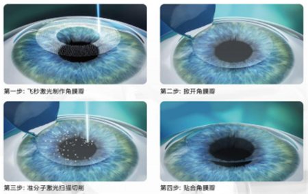 屈光矯視,希瑪瑞視眼科,上海眼科醫院