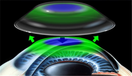 玻璃體視網(wǎng)膜,希瑪瑞視眼科,上海眼科醫(yī)院