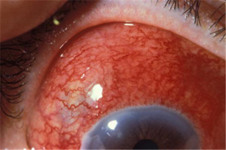 眼表眼角膜,?，斎鹨曆劭?上海眼科醫院