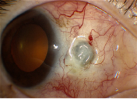 眼表眼角膜,?，斎鹨曆劭?上海眼科醫院