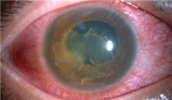 眼表眼角膜,?，斎鹨曆劭?上海眼科醫院