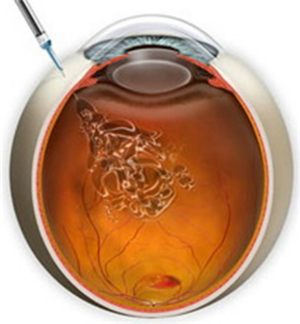 玻璃體視網膜,希瑪瑞視眼科,上海眼科醫院