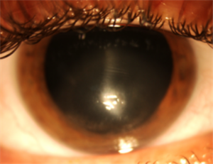 眼表眼角膜,希瑪瑞視眼科,上海眼科醫院 眼表眼角膜,希瑪瑞視眼科,上海眼科醫院