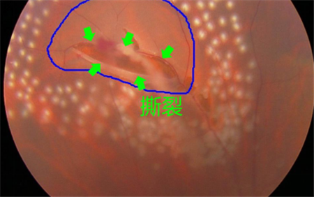 玻璃體視網(wǎng)膜,希瑪瑞視眼科,上海眼科醫(yī)院
